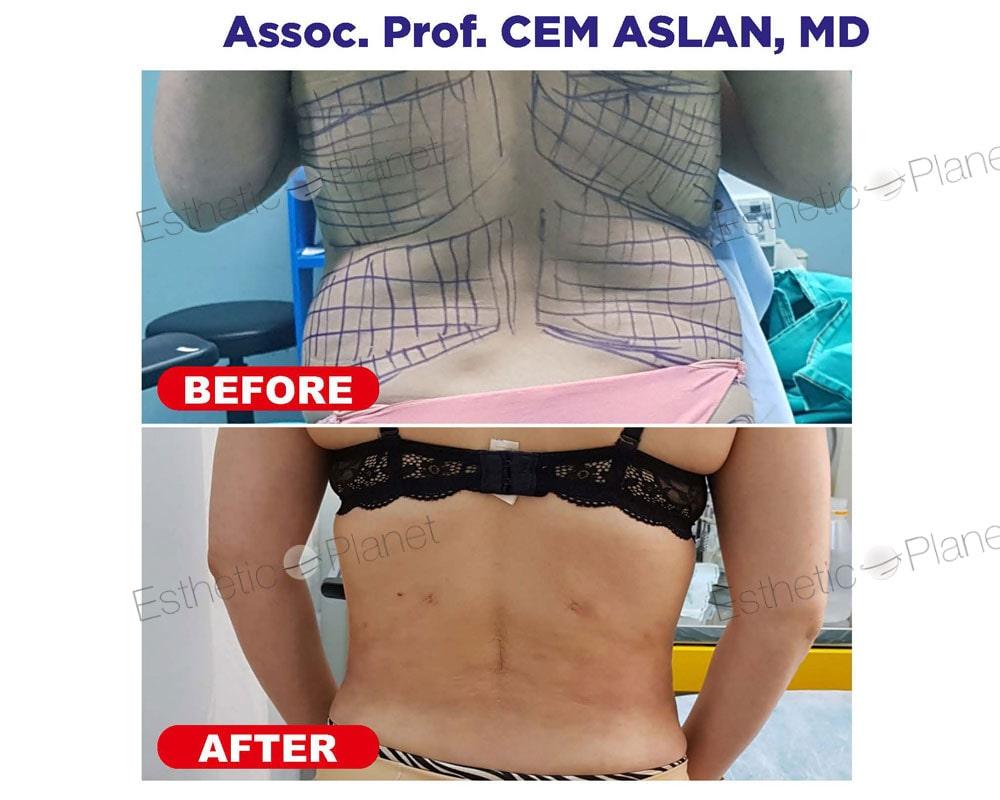 lipo6-min
