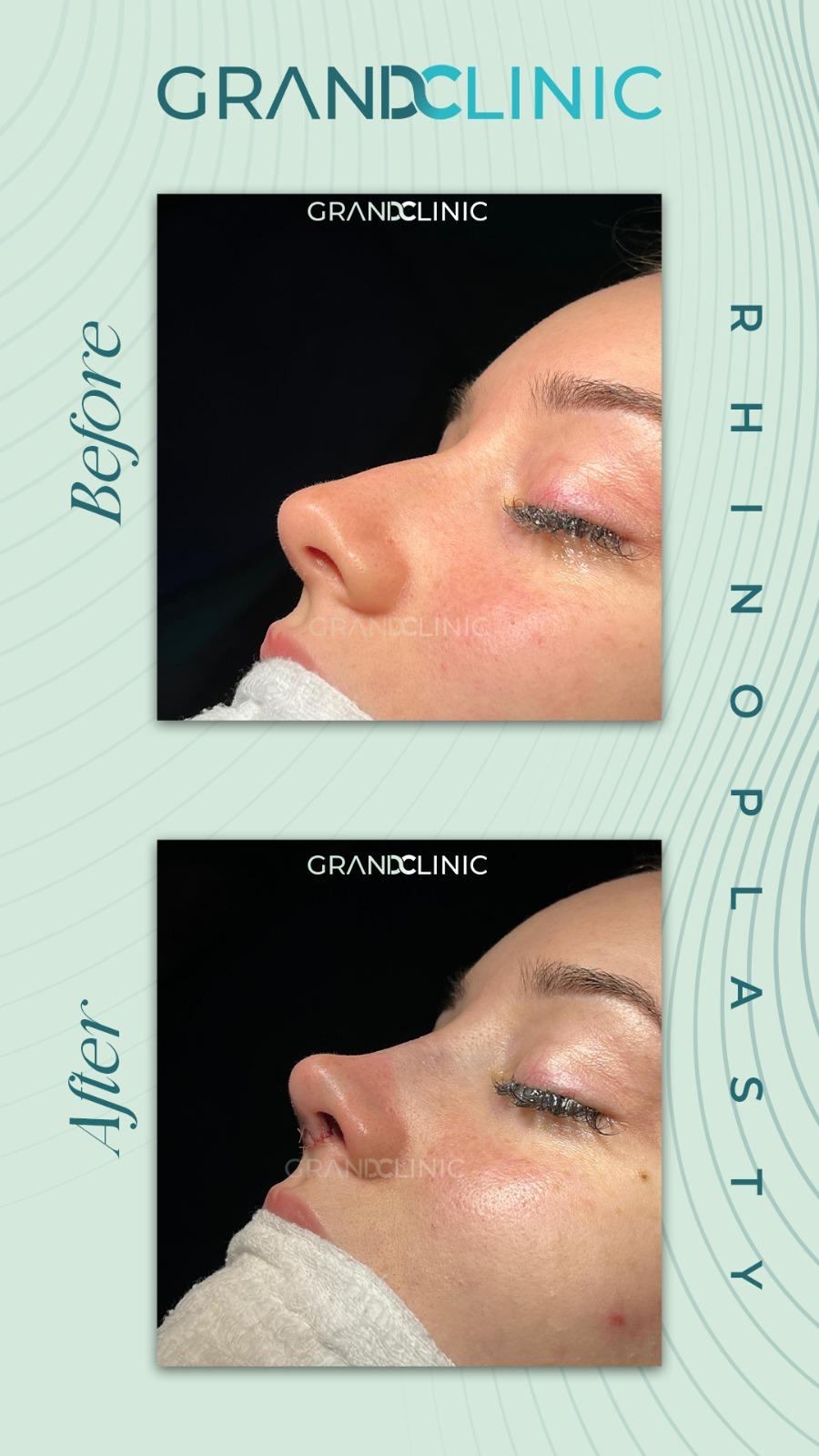 Rhinoplasty