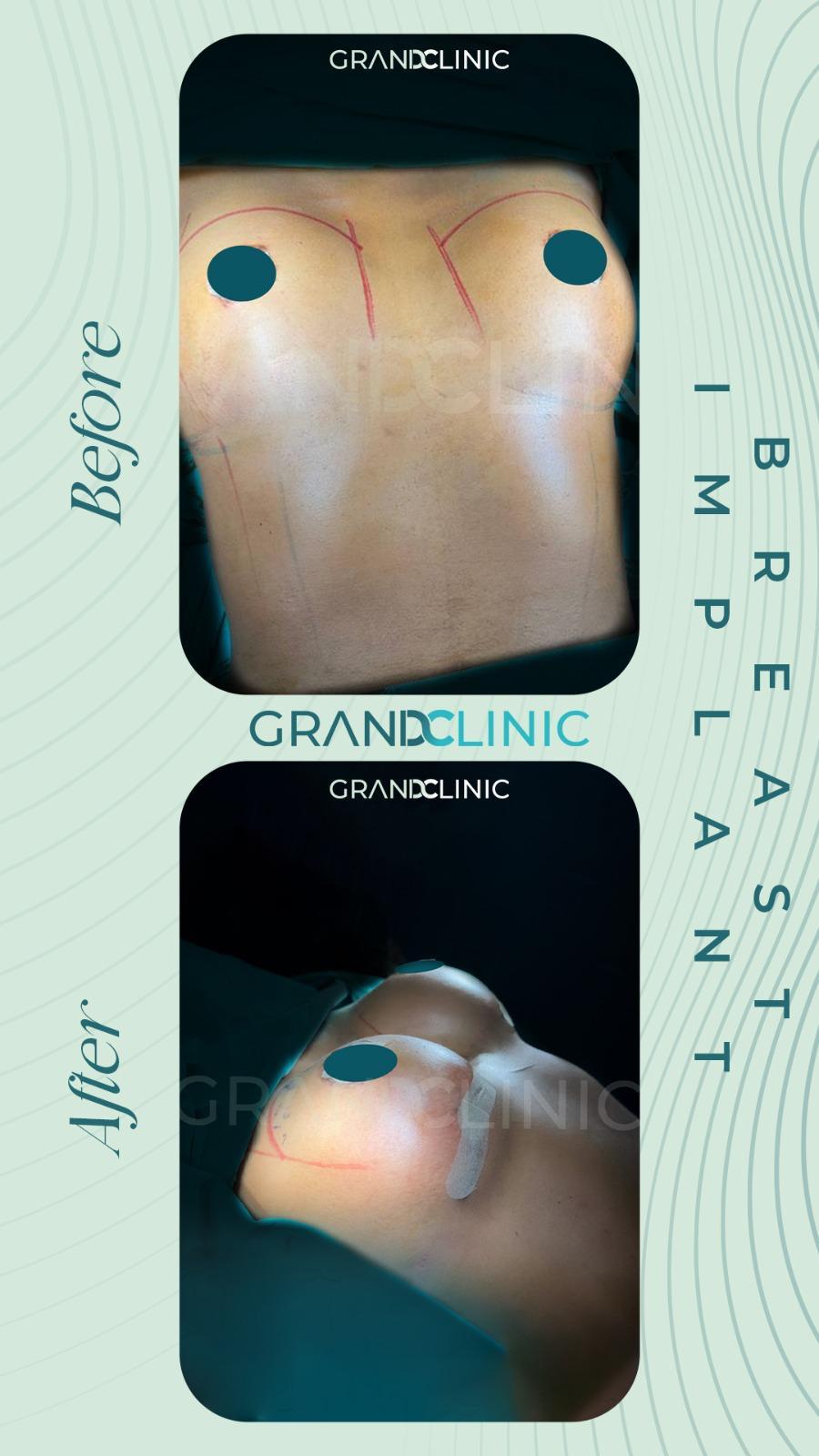Breast surgery