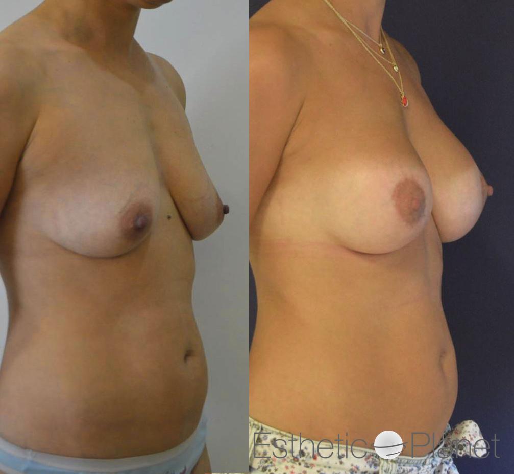 Lifting des seins, breast lift by Dr Ergin Er