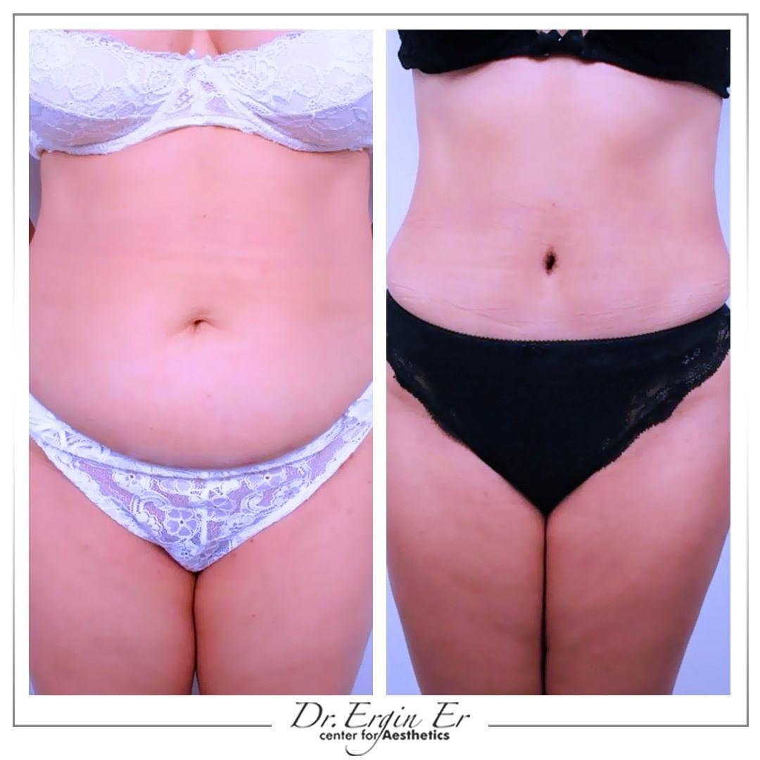 liposuccion by Dr Ergin Er