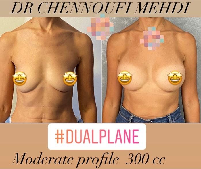 Breast Augmentation Mehdi Chennoufi 1