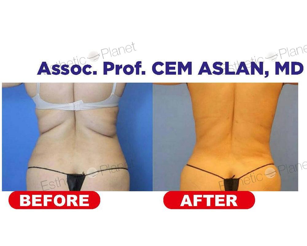 lipo1-min