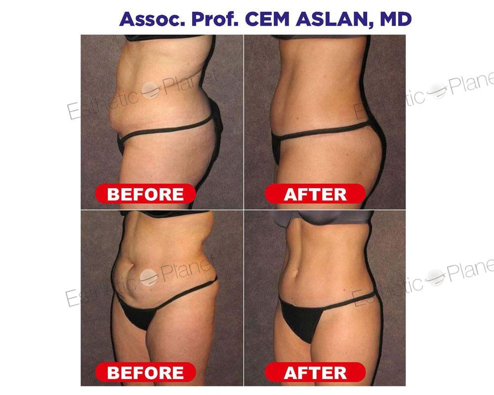 lipo2-min