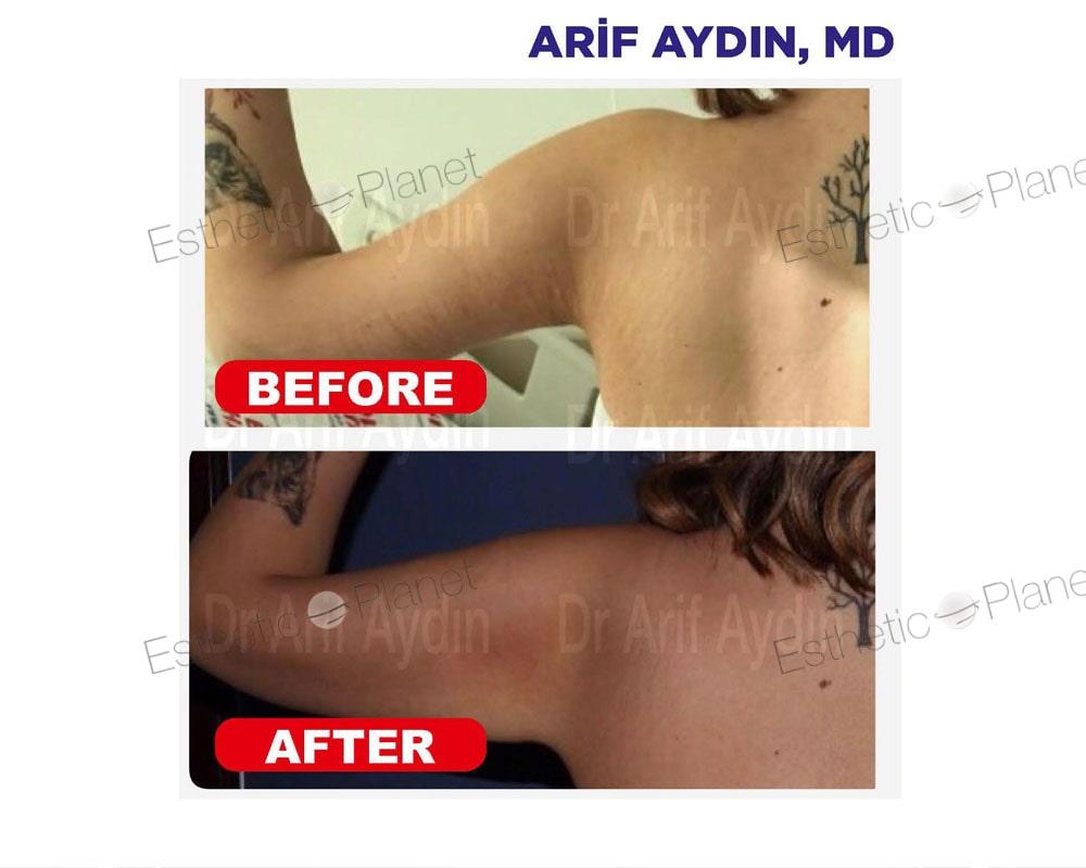 lipo3-min