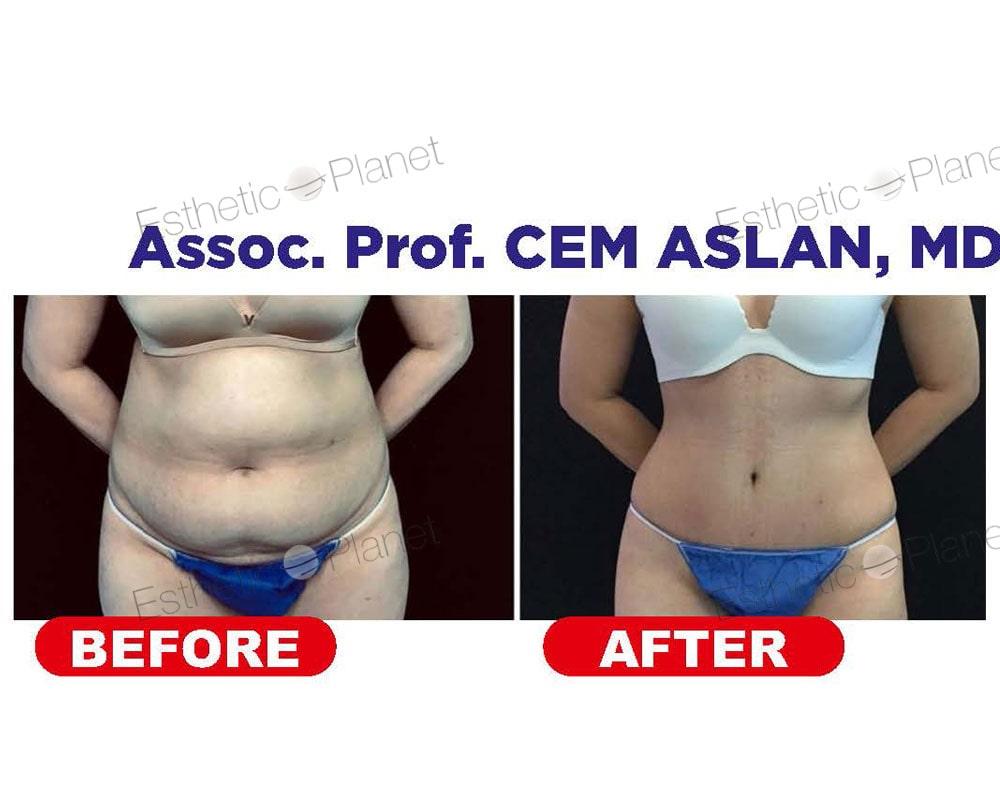lipo5-min