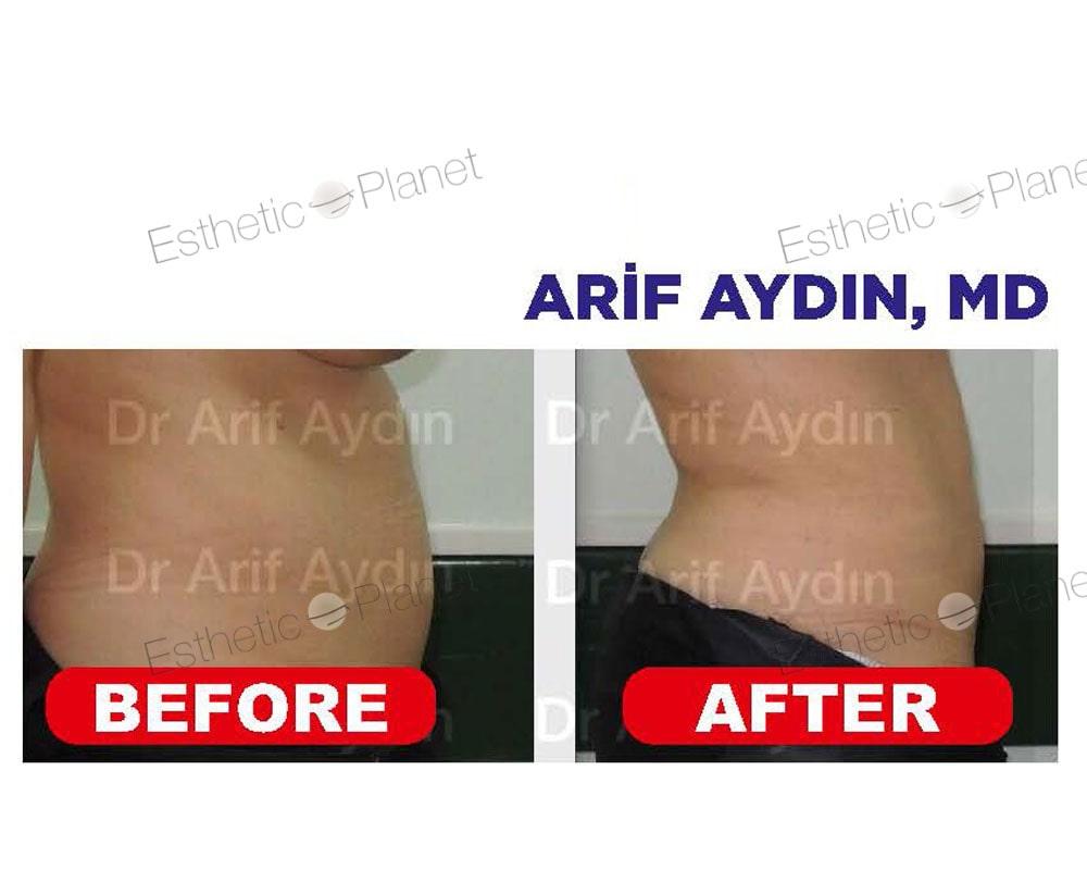 lipo7-min