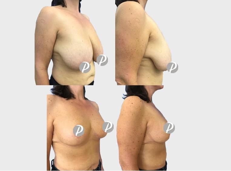 liftingseins-2-min