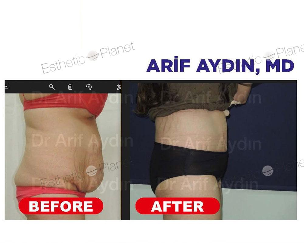 abdo1-min