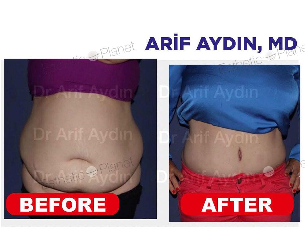 abdo4-min