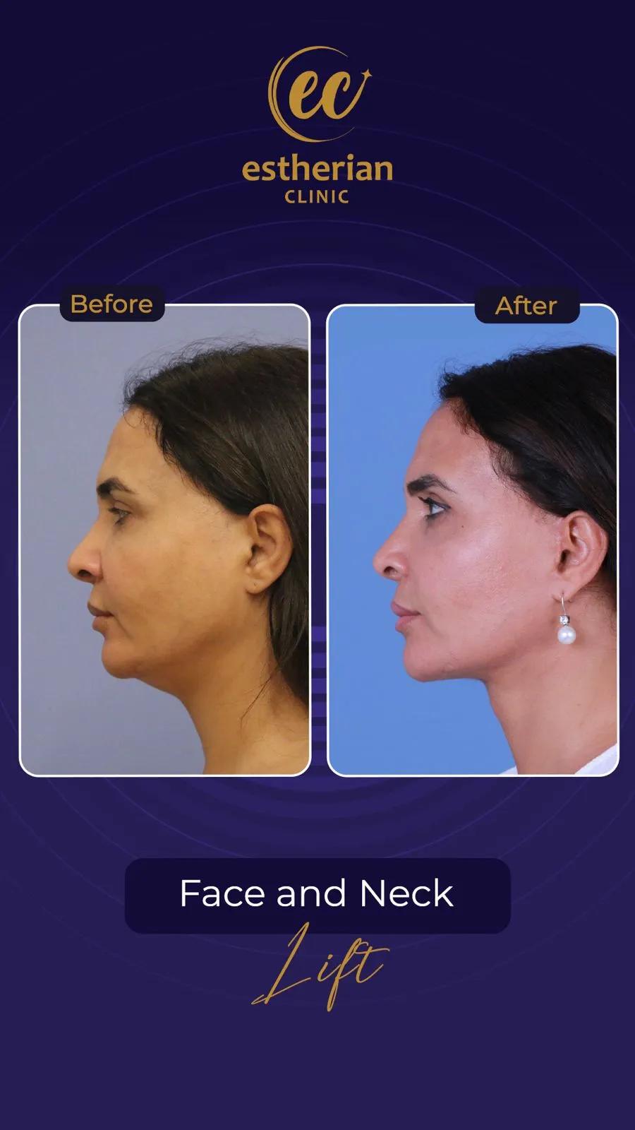 Face lift Turkey