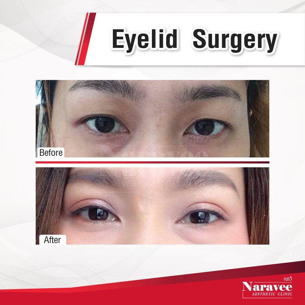 eyeslid1-min