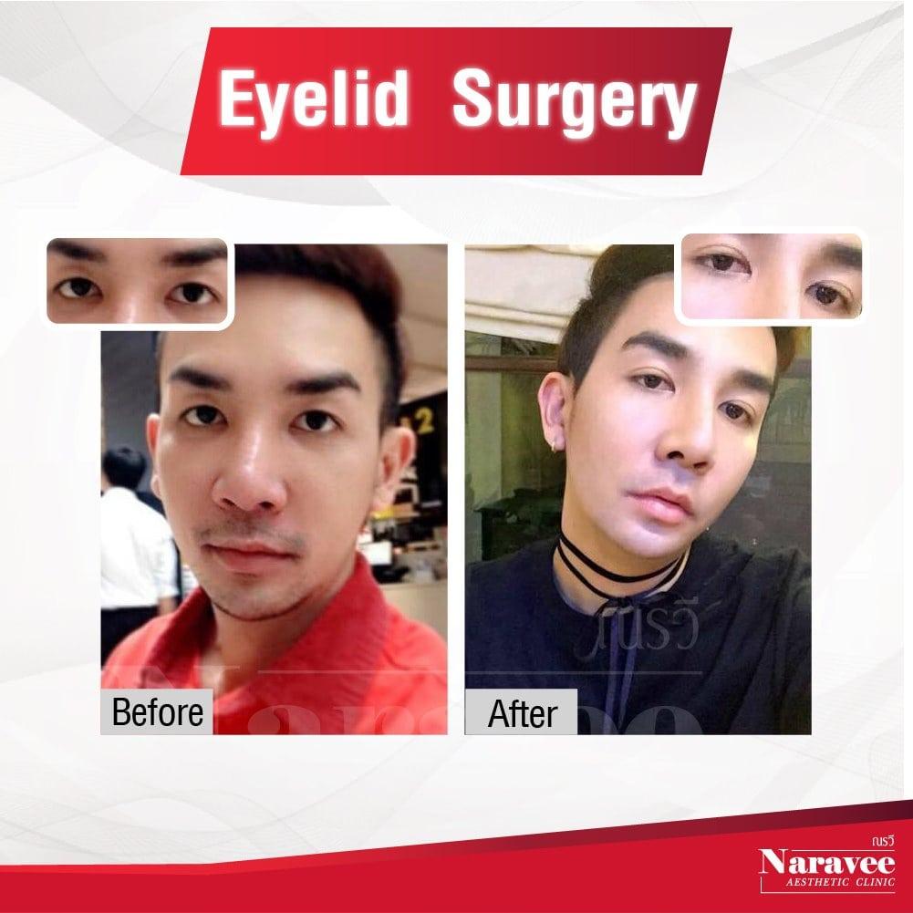 eyeslid2-min