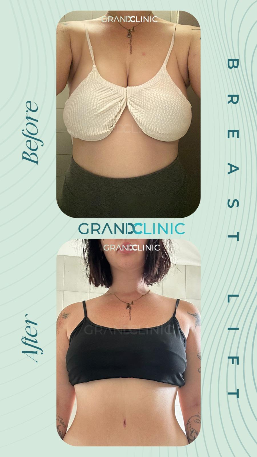 breast lift