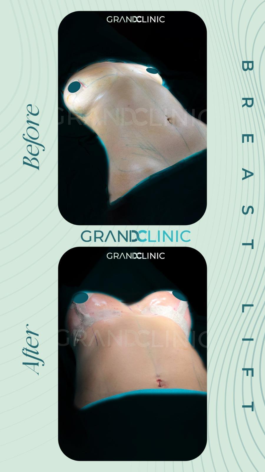 breast lift