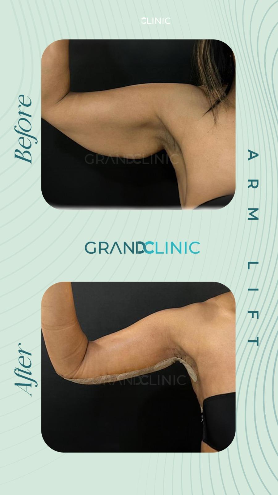 Arm Lift Istanbul