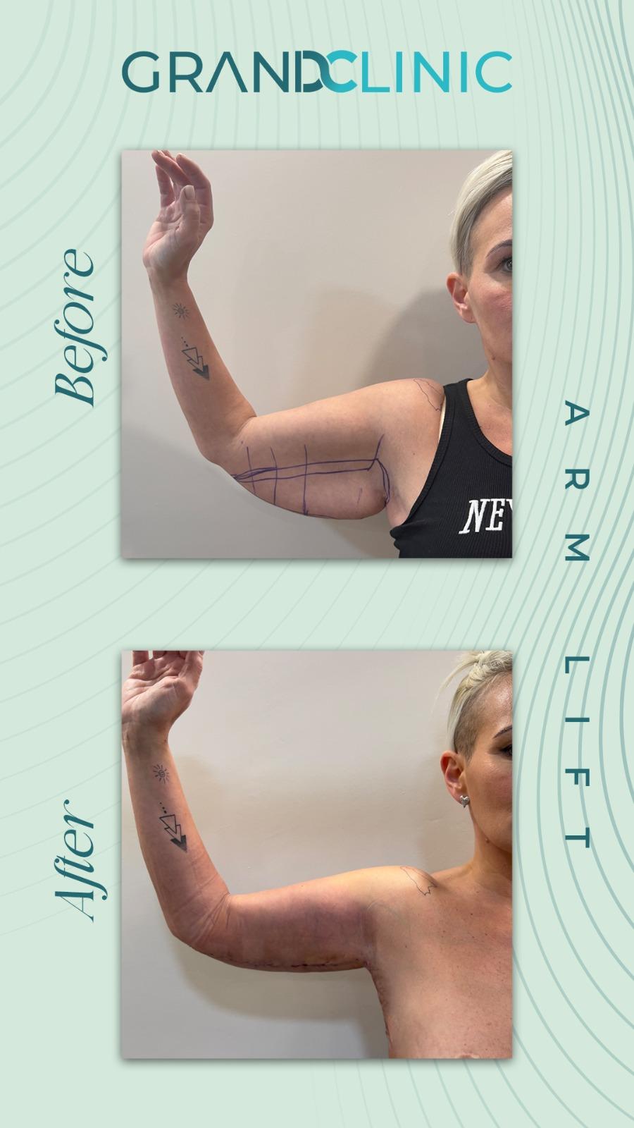 Arm Lift Istanbul