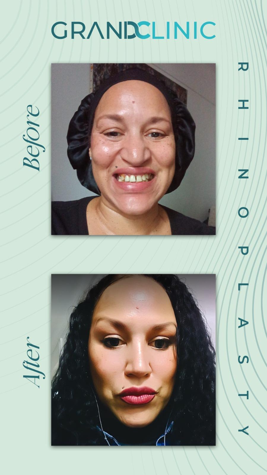 Rhinoplasty