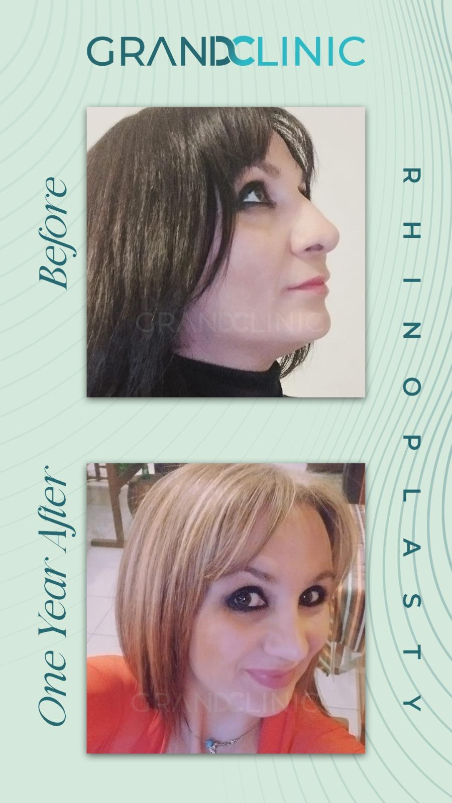 Rhinoplasty