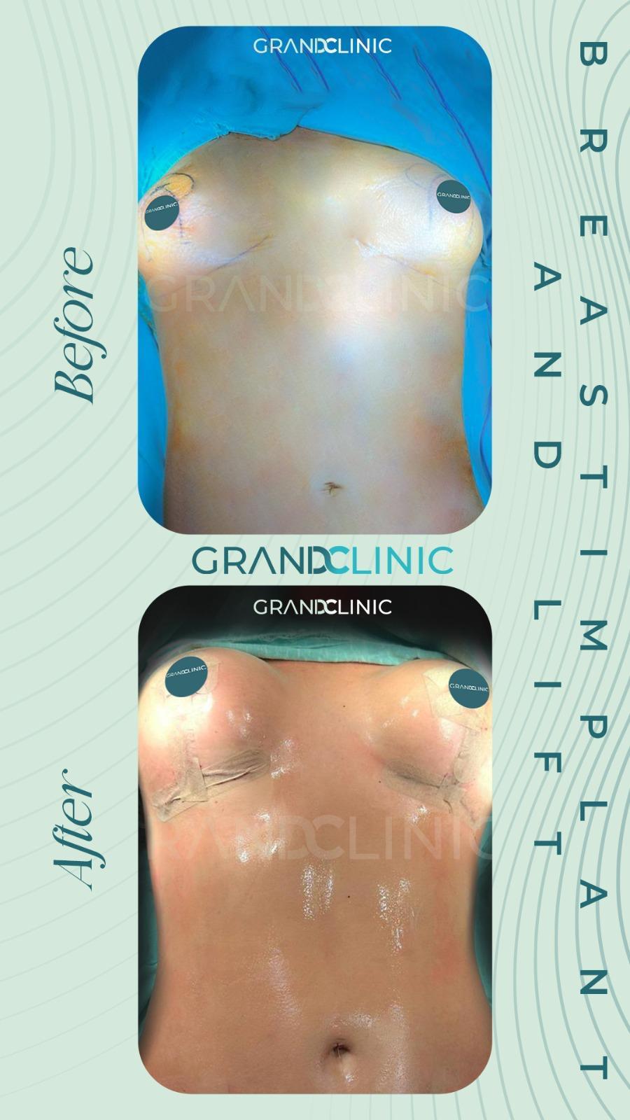 breast surgery