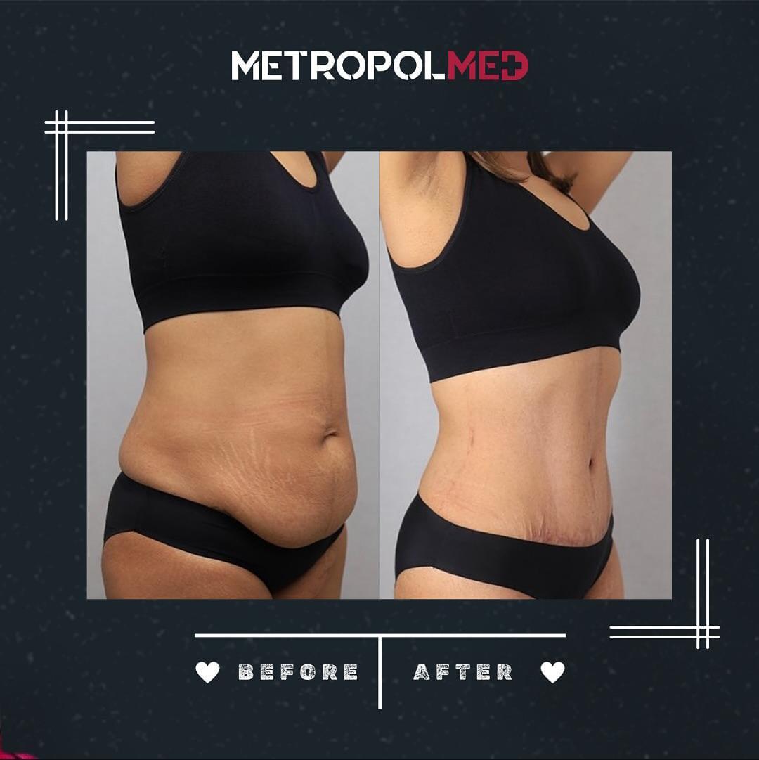 Tummy Tuck