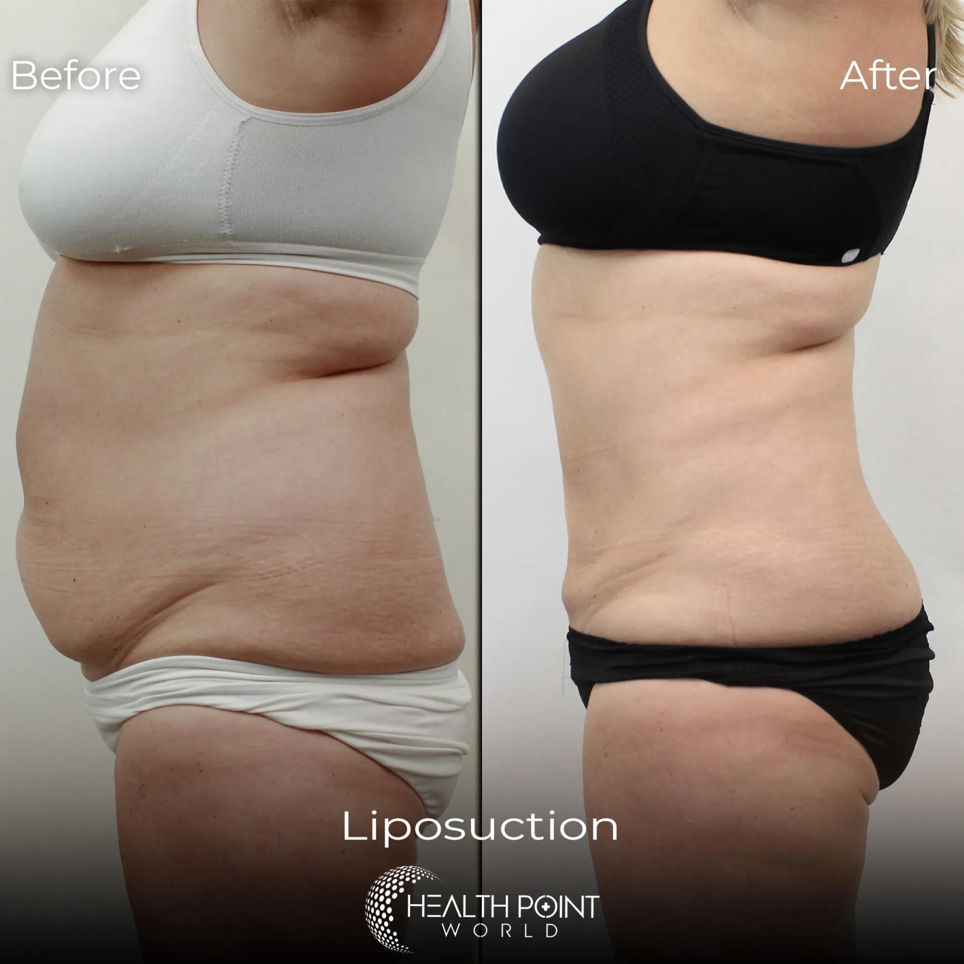 Liposuccion