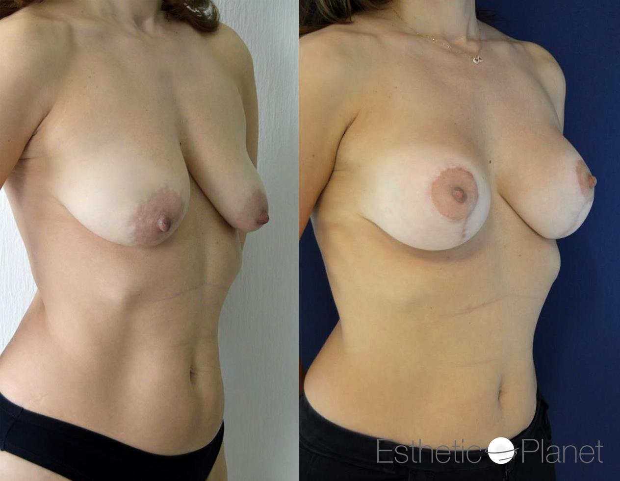 Lifting des seins, breast lift by Dr Ergin Er