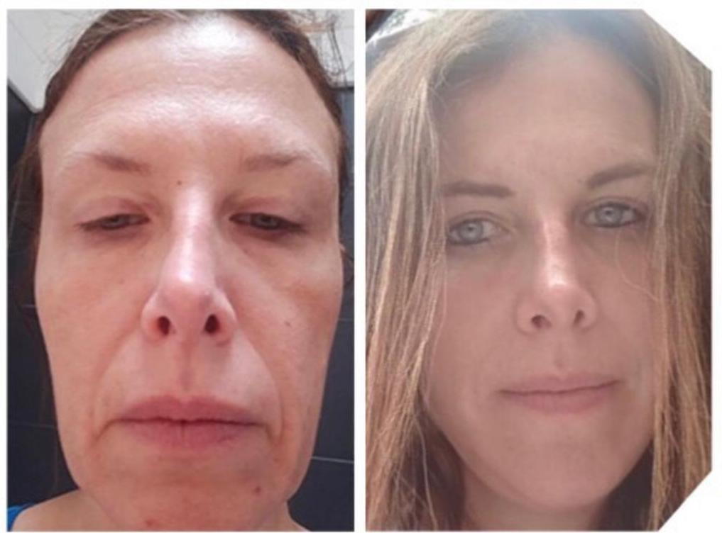 Face Lift by Dr Ergin Er