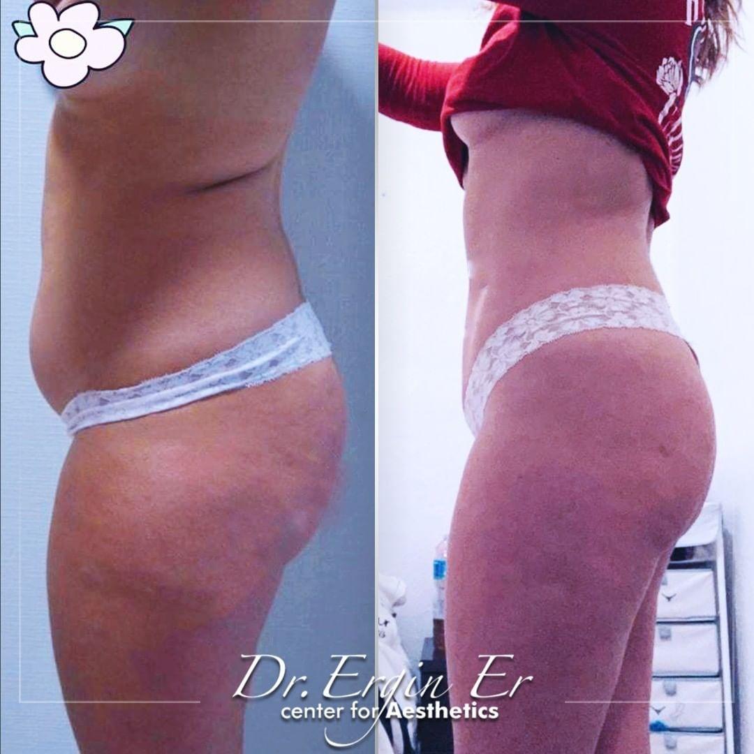liposuccion by Dr Ergin Er