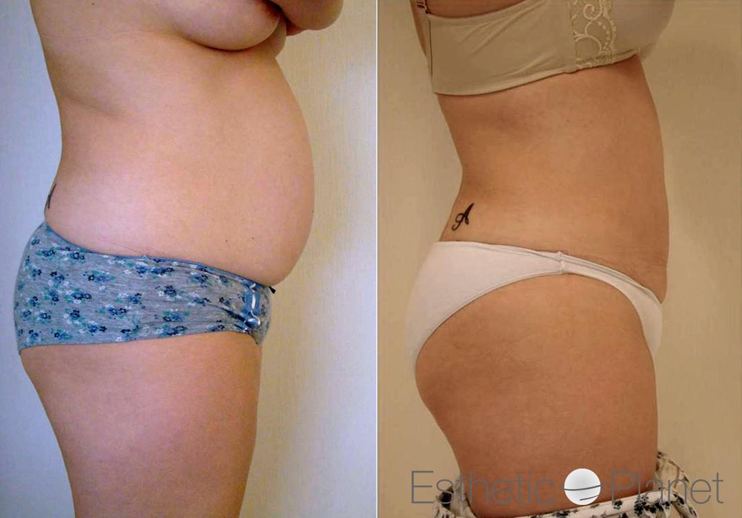 liposuccion by Dr Ergin Er