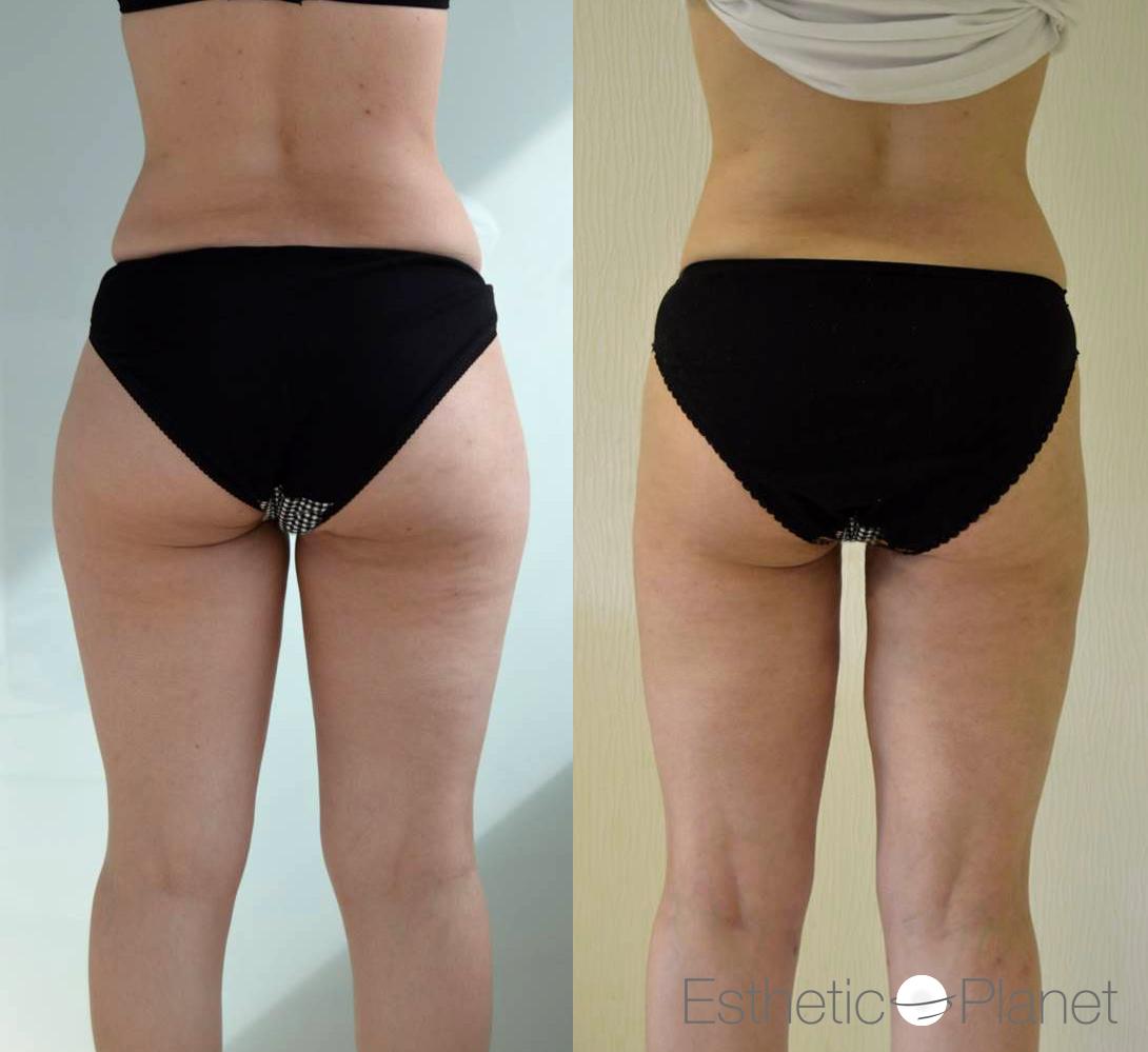 liposuccion by Dr Ergin Er