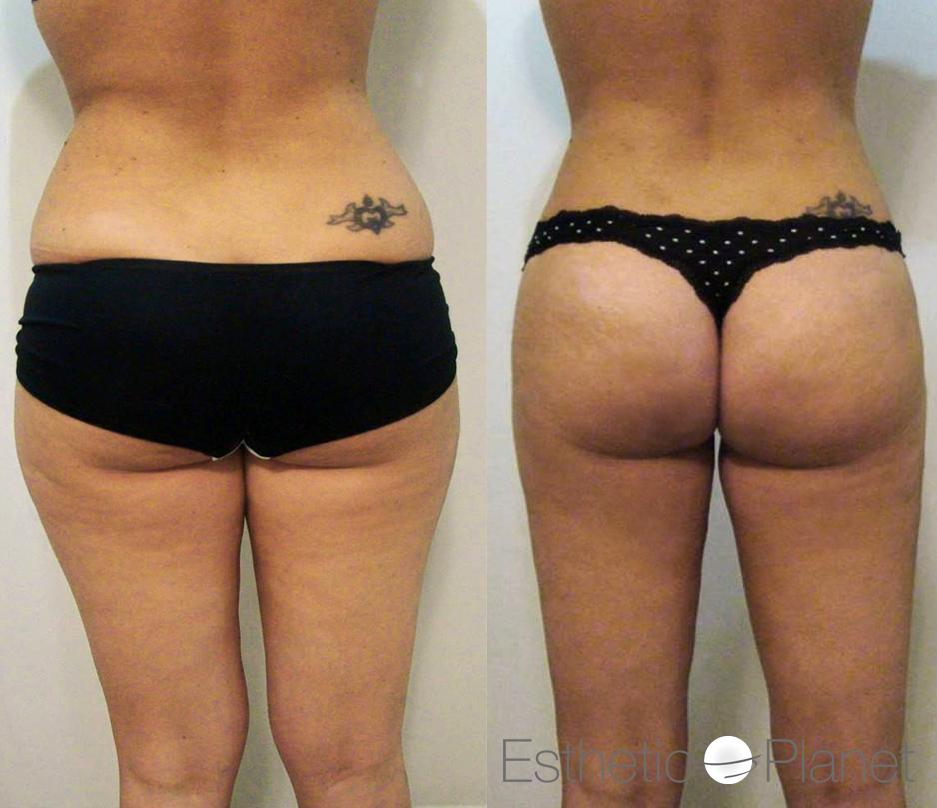 liposuccion by Dr Ergin Er