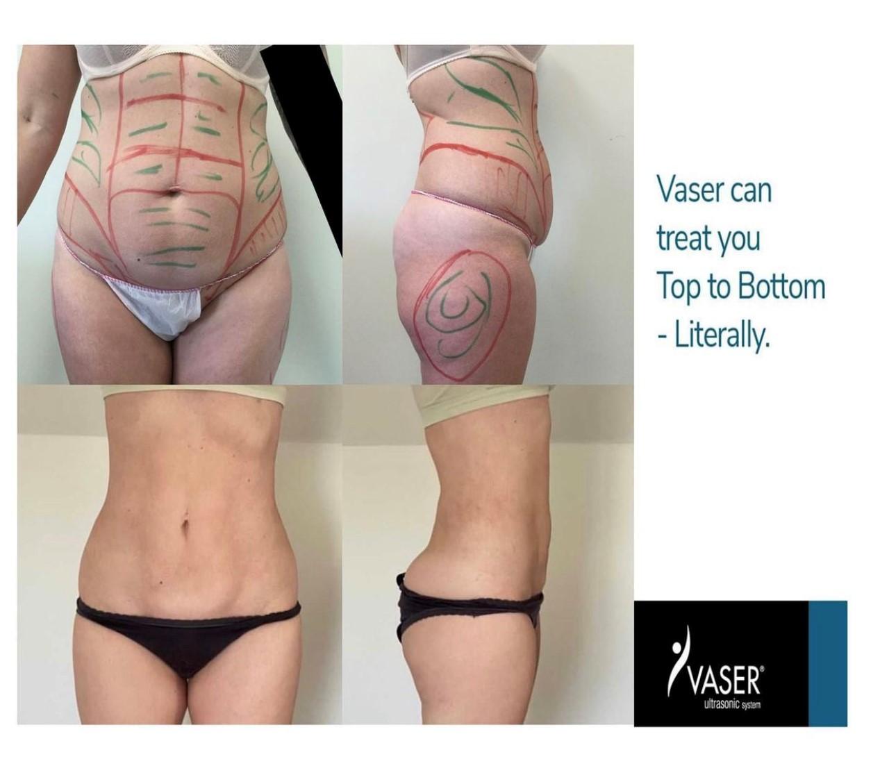 Lipo complète
