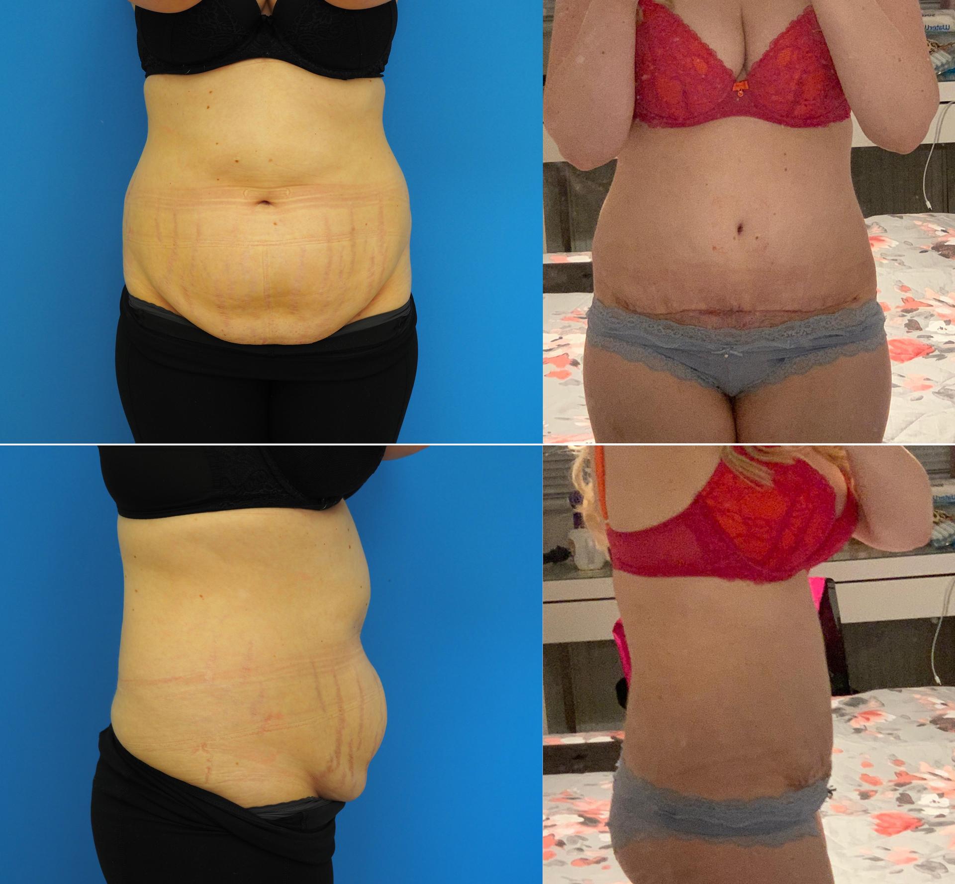 Abdominoplastie 1mois après / 1 month after