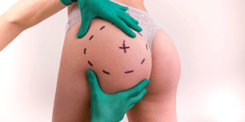 Implants fessiers
