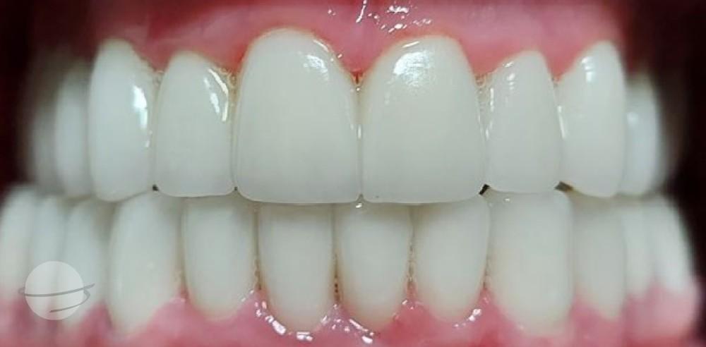 After Veneers / Après facettes