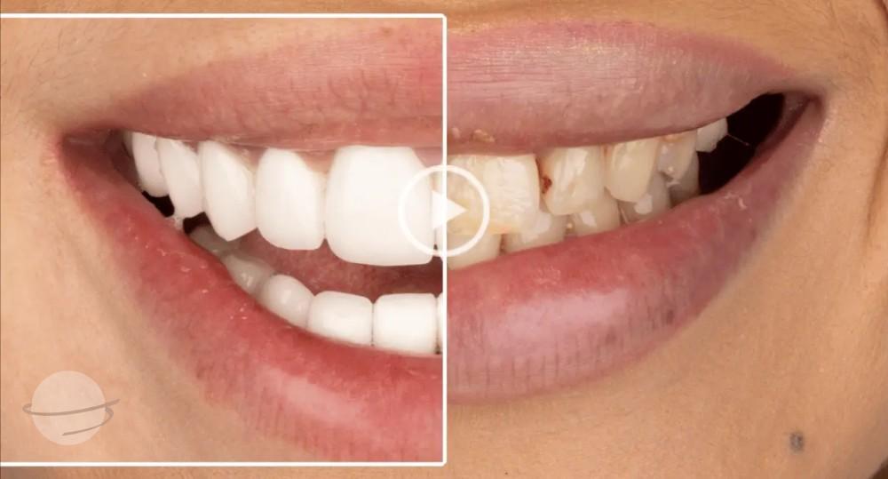 emax veneers results Dentaglobal Turkey