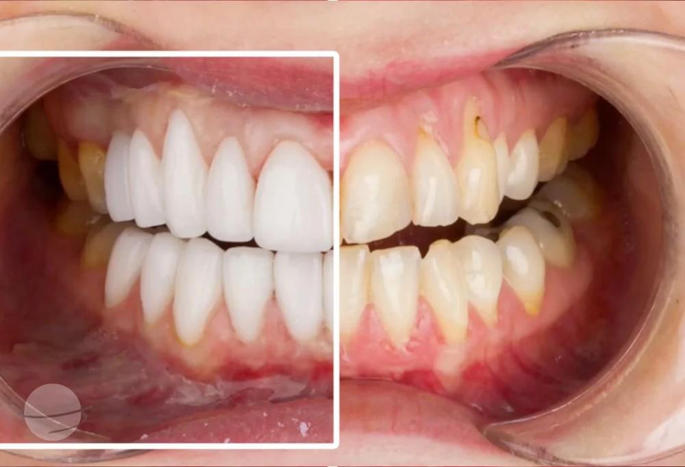 emax veneers results Dentaglobal Turkey