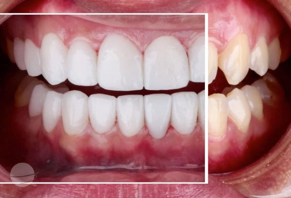 emax veneers results Dentaglobal Turkey