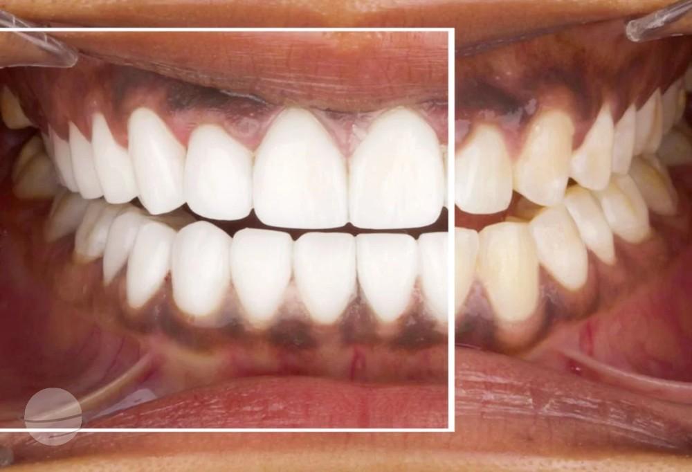 emax veneers results Dentaglobal Turkey