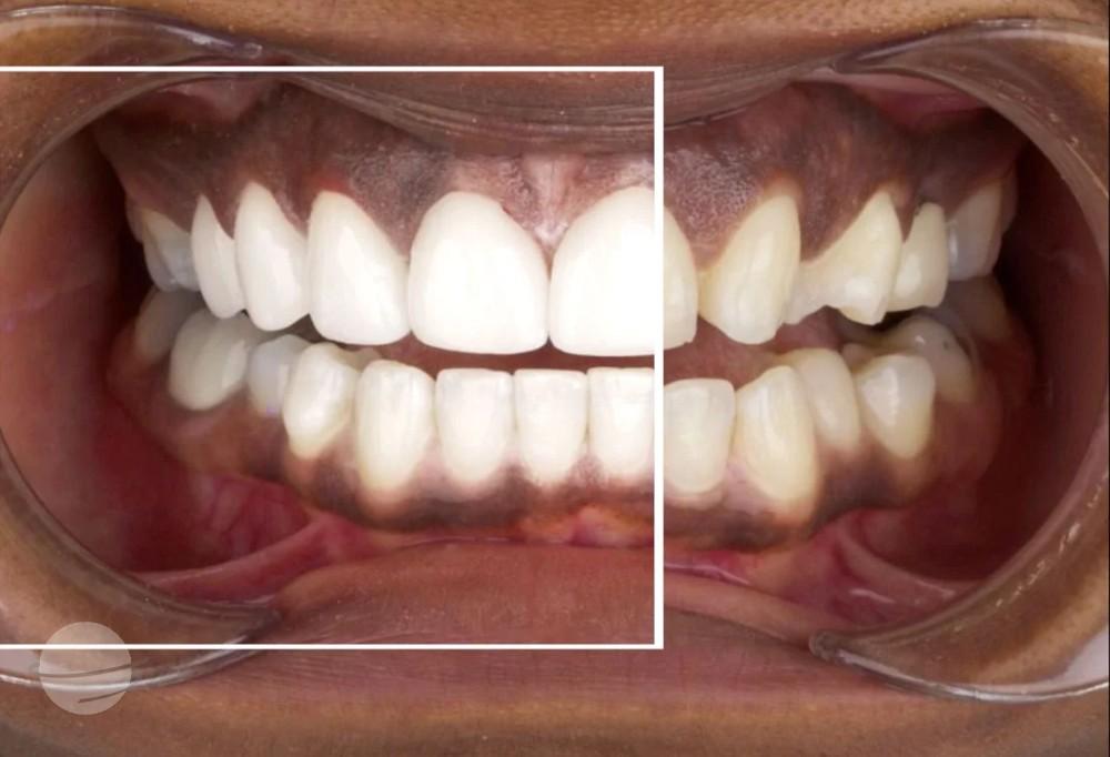 emax veneers results Dentaglobal Turkey