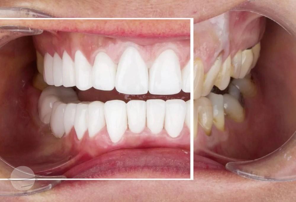 emax veneers results Dentaglobal Turkey