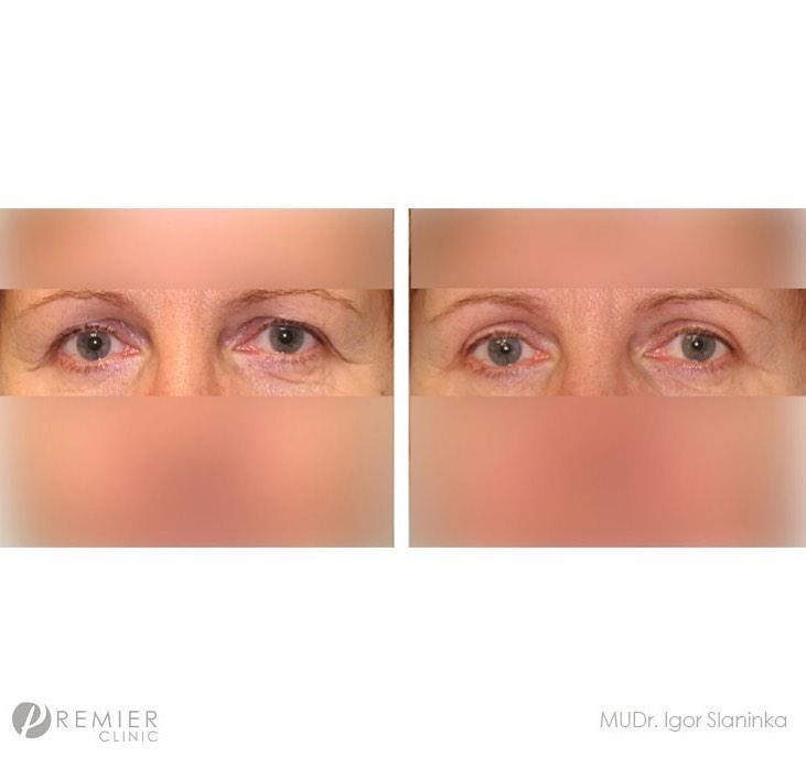 blepharoplasty by Premier Clinic