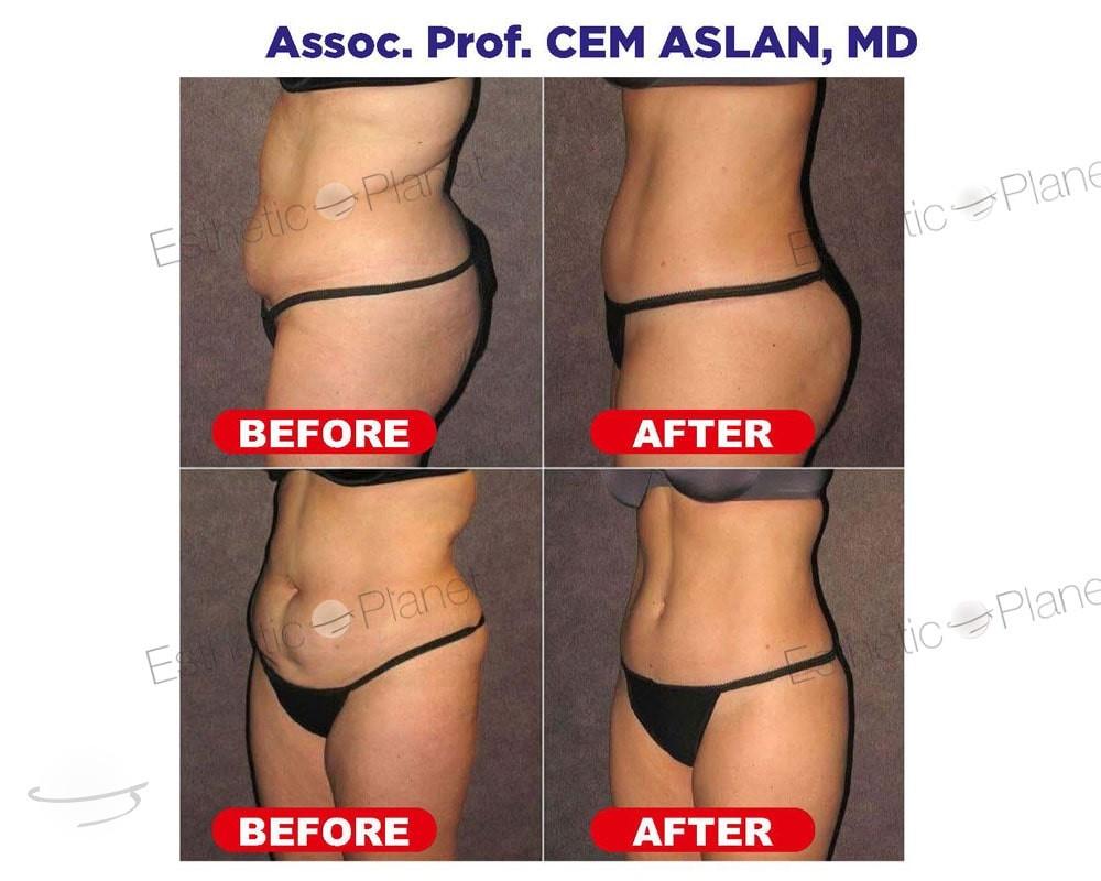 Liposuccion