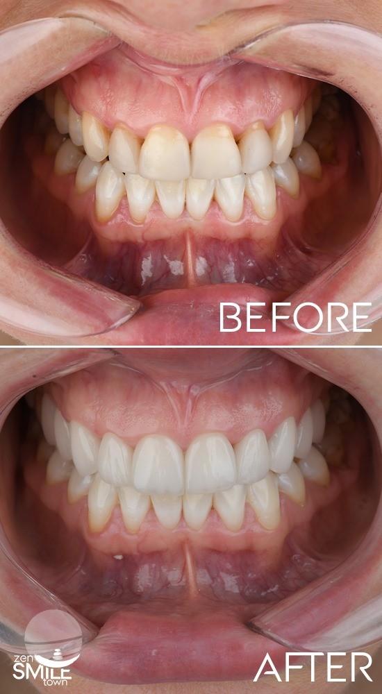 DENTAL TURKEY - COMPOSITE BONDING RESULTS3