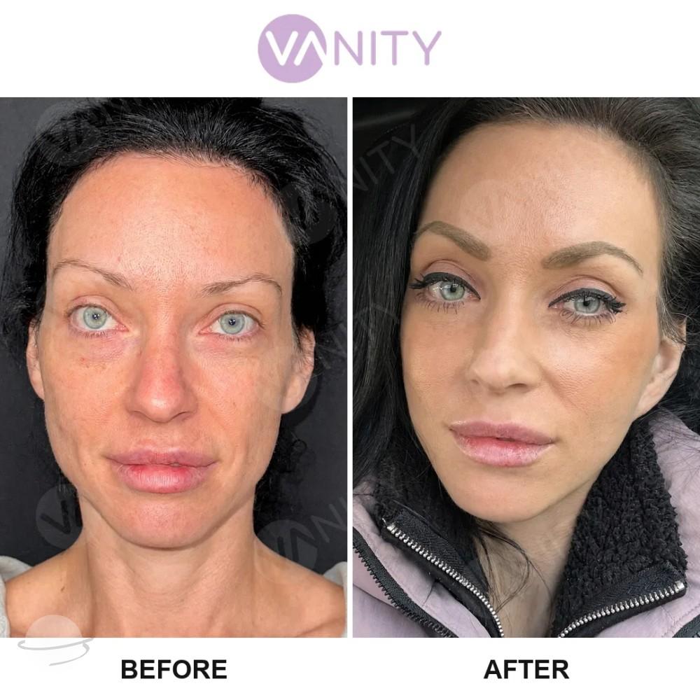 Lifting du visage