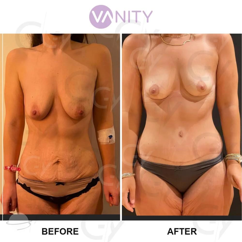 Abdominoplastie