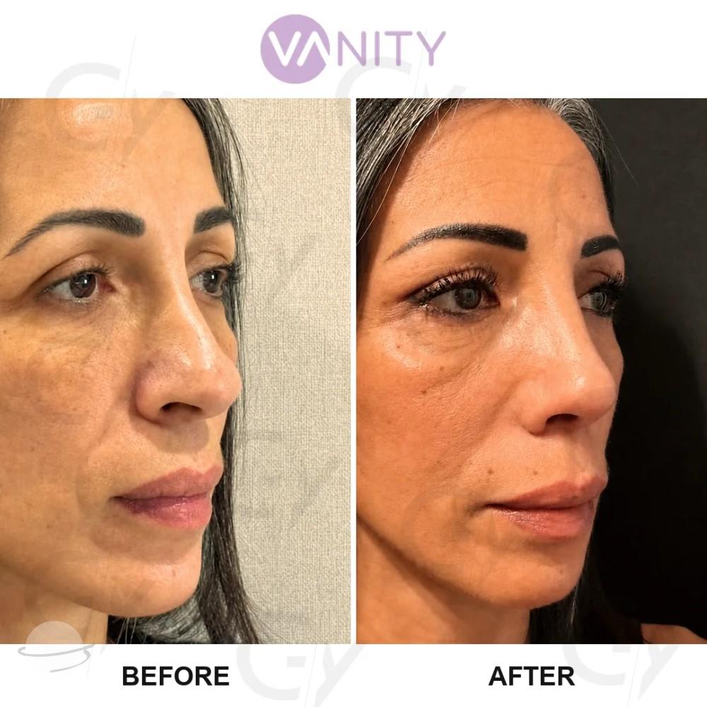 Rhinoplastie