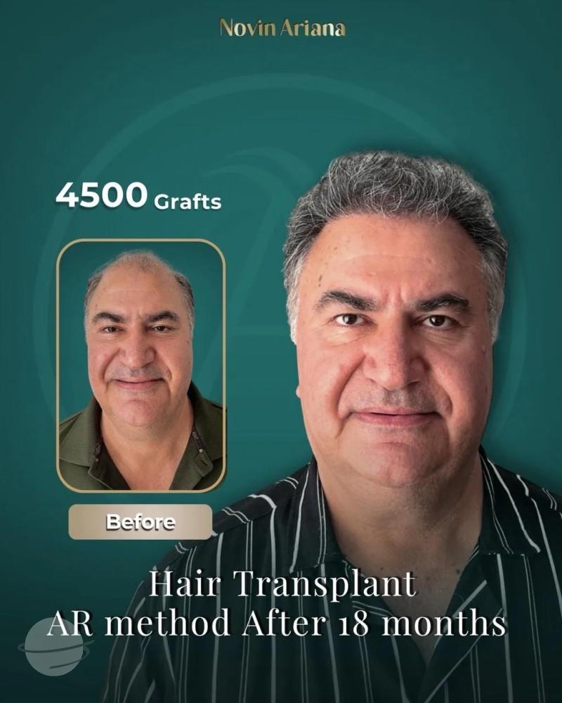 FUE