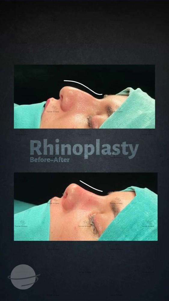 Rhinoplastie